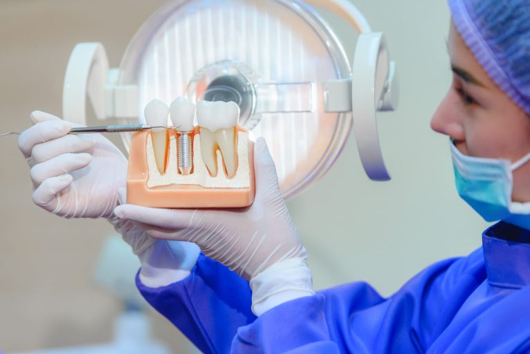 how dental implants boost long-term oral health